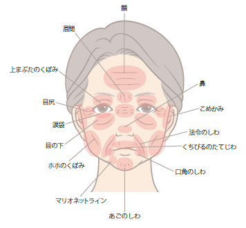 顔のヒアルロン酸の注入可能部位
