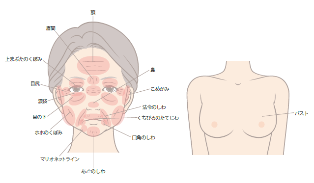ヒアルロン酸の注入可能部位