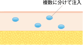 複数に分けて注入