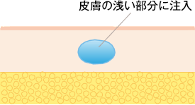 皮膚の浅い部分に注入