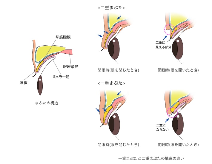 まぶたの構造 拳筋腱膜 眼瞼拳筋 瞼板 ミュラー筋 一重まぶたと二重まぶたの構造の違い ＜二重まぶた＞閉眼時（眼をとじたとき） 開眼時（目を開いたとき）二重に見える部分 ＜一重まぶた＞閉眼時（眼を閉じたとき） 開眼時（目を開いたとき） 二重にならない 