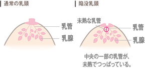 【通常の乳頭】　【陥没乳頭】中央の一部の乳管が、未熟でつっぱっている