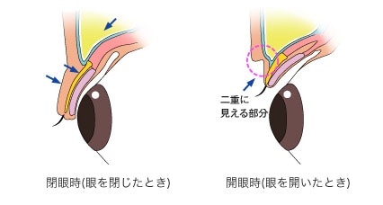 二重まぶたの構造