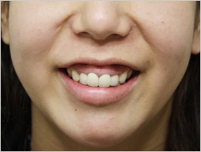 笑うと歯茎が出るガミースマイルの原因は 骨格 歯並び 上唇の筋肉 歯茎の粘膜 Dr 高須幹弥の美容整形講座 美容整形の高須クリニック