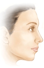 ヒアルロン酸が入っている鼻にプロテーゼを入れる場合はどうするのか Dr 高須幹弥の美容整形講座 美容整形の高須クリニック