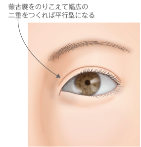 末広型 重と平 型 重はどちらが が きく える 然に えるのはどちら 高須クリニック