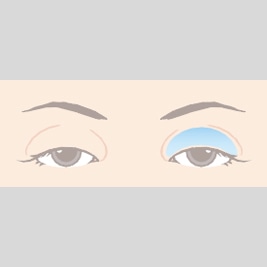 朝起きたときにまぶたが浮腫んで腫れぼったくなるのは 二重まぶた埋没法や切開法で改善するのか Dr 高須幹弥の美容整形講座 美容整形の高須クリニック