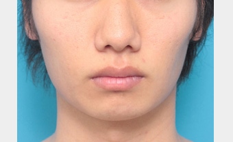 小顔 エラを目立たなく タイプ別すっきりシャープな顔への近道 男性整形特集 美容整形の高須クリニック 小顔 エラを目立たなく タイプ別すっきりシャープな顔への近道 男性整形特集 美容整形の高須クリニック