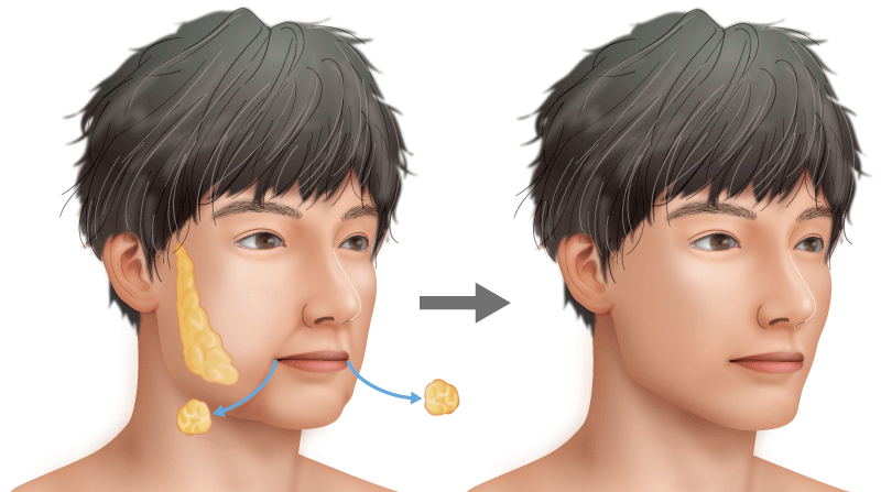 小顔 エラを目立たなく タイプ別すっきりシャープな顔への近道 男性整形特集 美容外科 高須クリニック