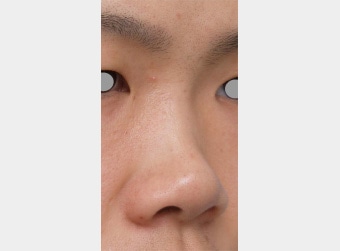 鼻 すっと高く 成功する鼻筋への近道 男性整形特集 美容整形の高須クリニック