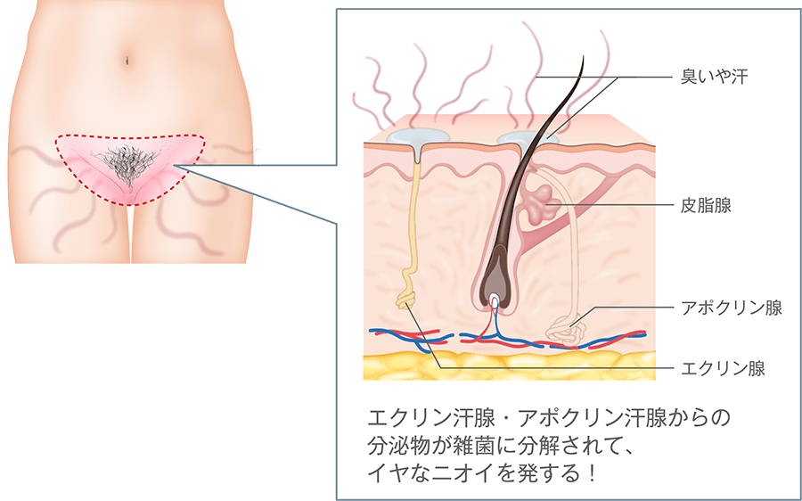 エクリン汗腺・アポクリン汗腺からの分泌物が雑菌に分解されて、イヤなニオイを発する！